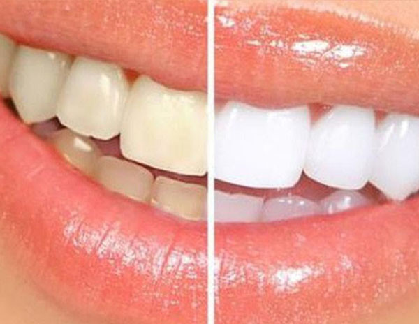 Что такое отбеливание зубов? Как?