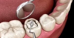 Diş Dolgusu Nedir