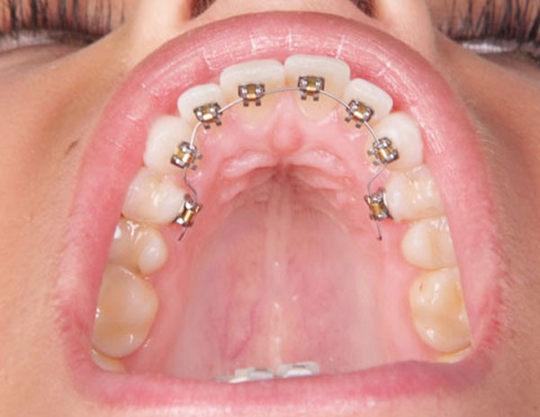 Ortodonti ve Braketlerle İlgili Bilmemiz Gerekenler