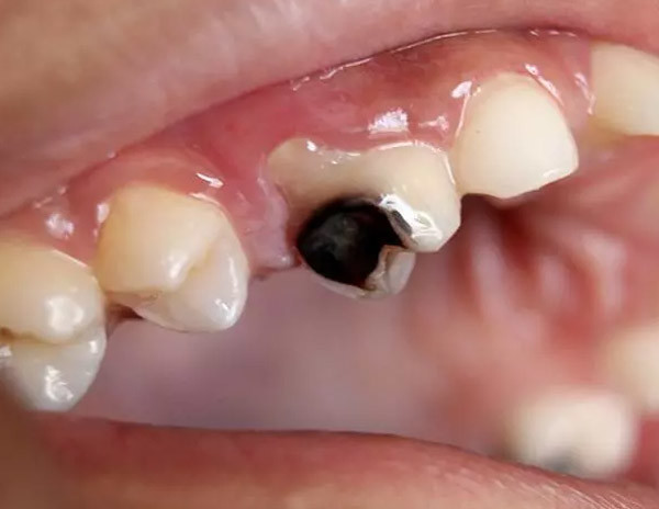 Tedavi Edilmeyen Çürük Dişlerin Vücudumuza Zararları