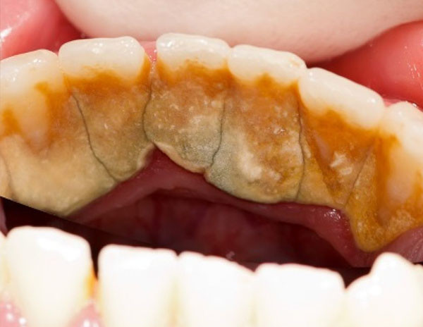 Что такое зубной камень?