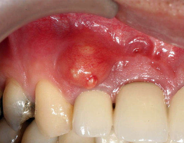 Что такое зубная киста?