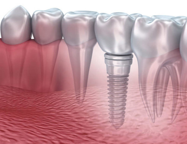 implant tedavisi
