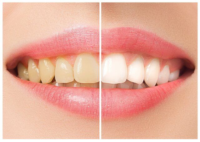 diş beyazlatma nasıl yapılır