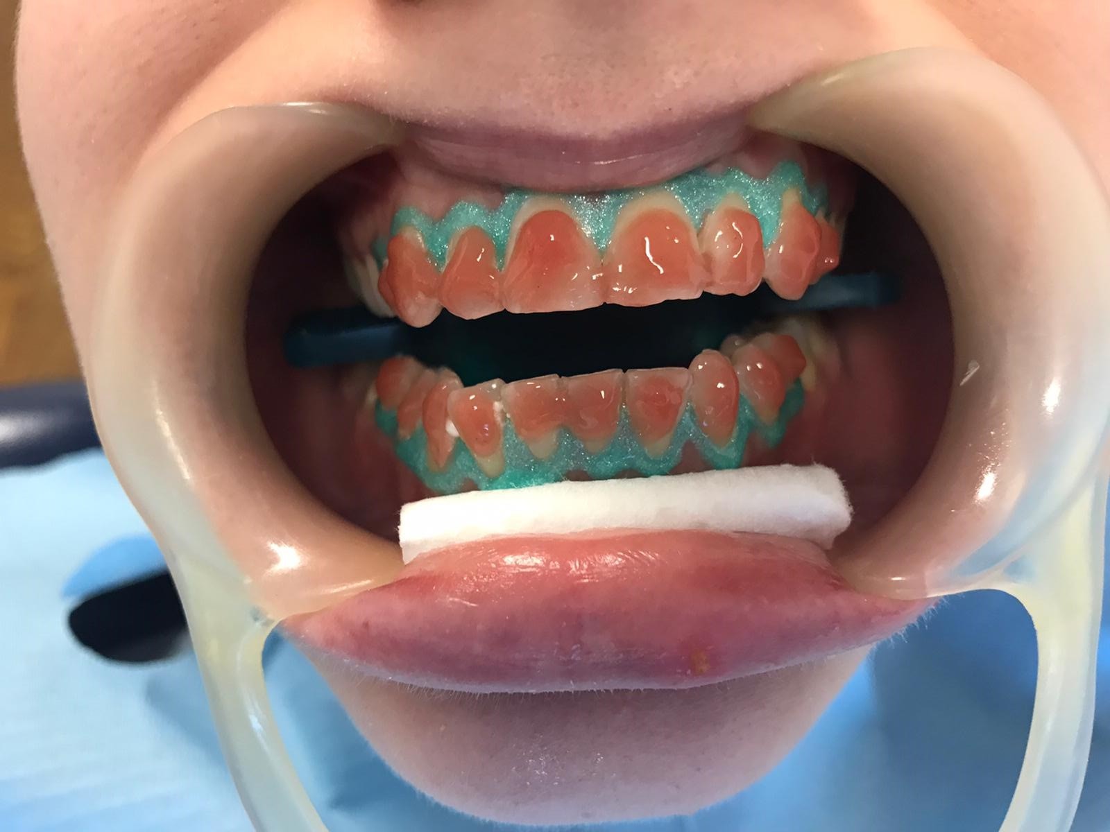 Profesyonel Diş Beyazlatma