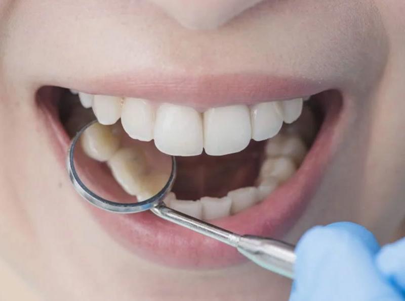 Diş Dolgu NEDİR? DOLGU malzemeleri nelerdir?