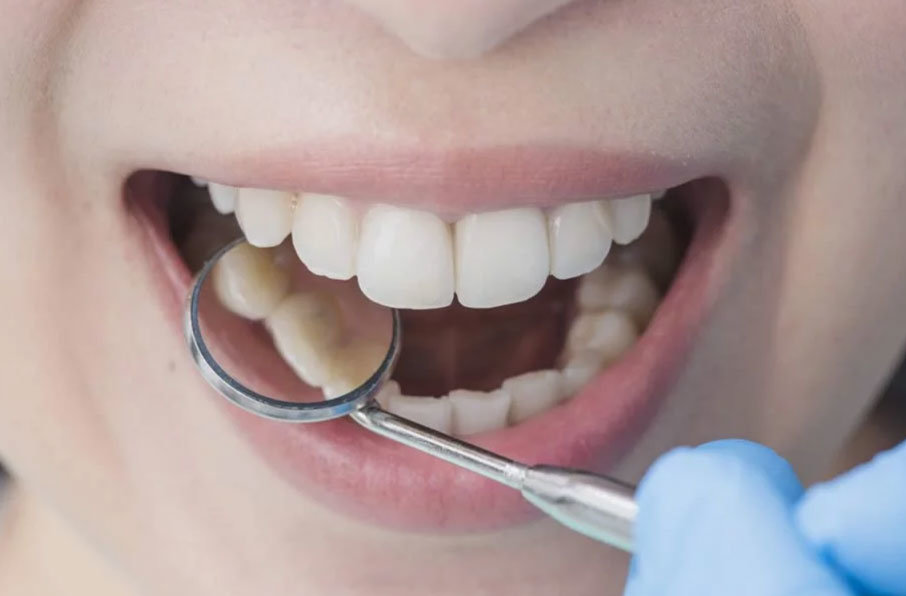 Diş Dolgu NEDİR? DOLGU malzemeleri nelerdir?