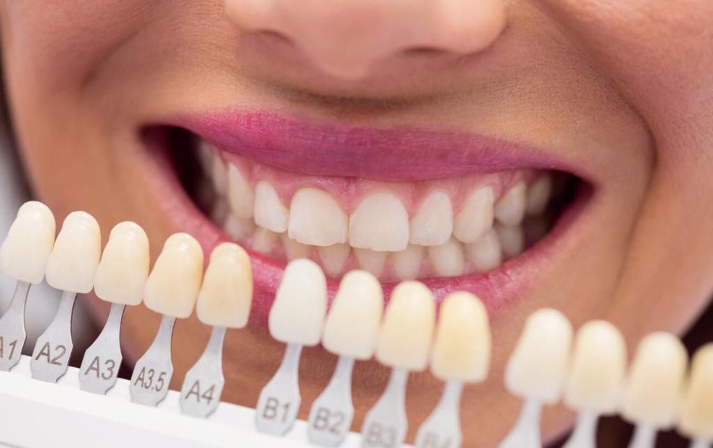 Срок службы ламинированных зубов