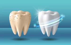 Лечение отбеливания зубов