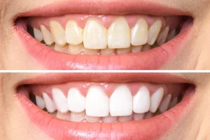 Лечение отбеливания зубов