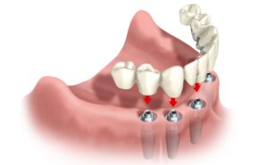 Виды зубных протезов 