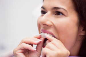 Выпрямление зубов без проводов