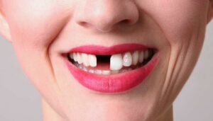Лечение отсутствующего зуба