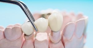 Коронный мостовой протез