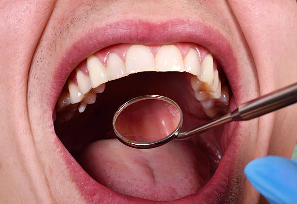 Çürük Diş Tedavisi