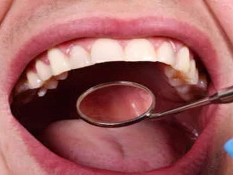 Çürük Diş Tedavisi