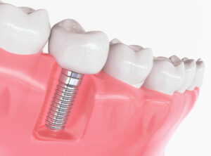 Виды стоматологического лечения