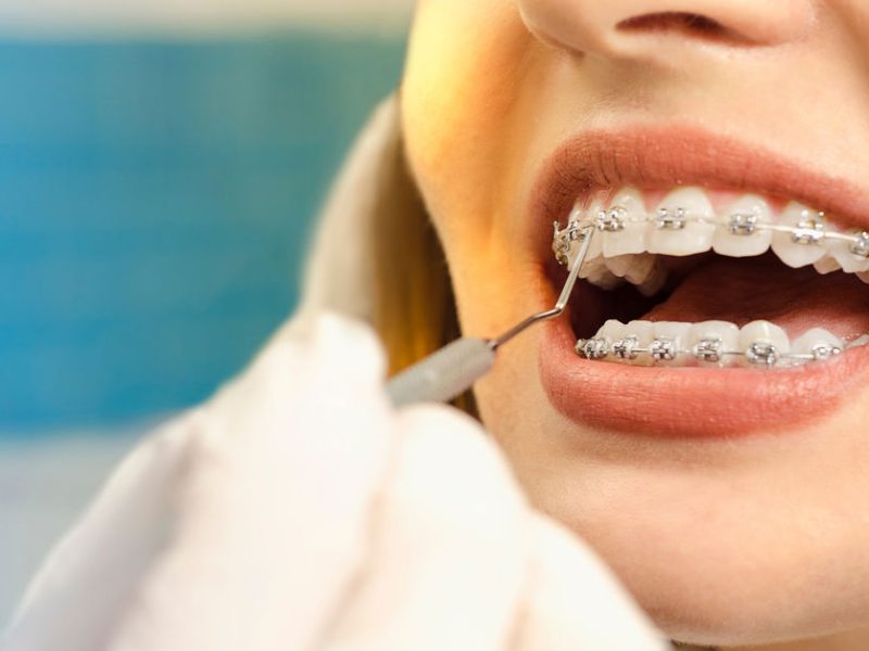 Diş Teli Çeşitleri