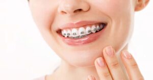 Виды брекетов