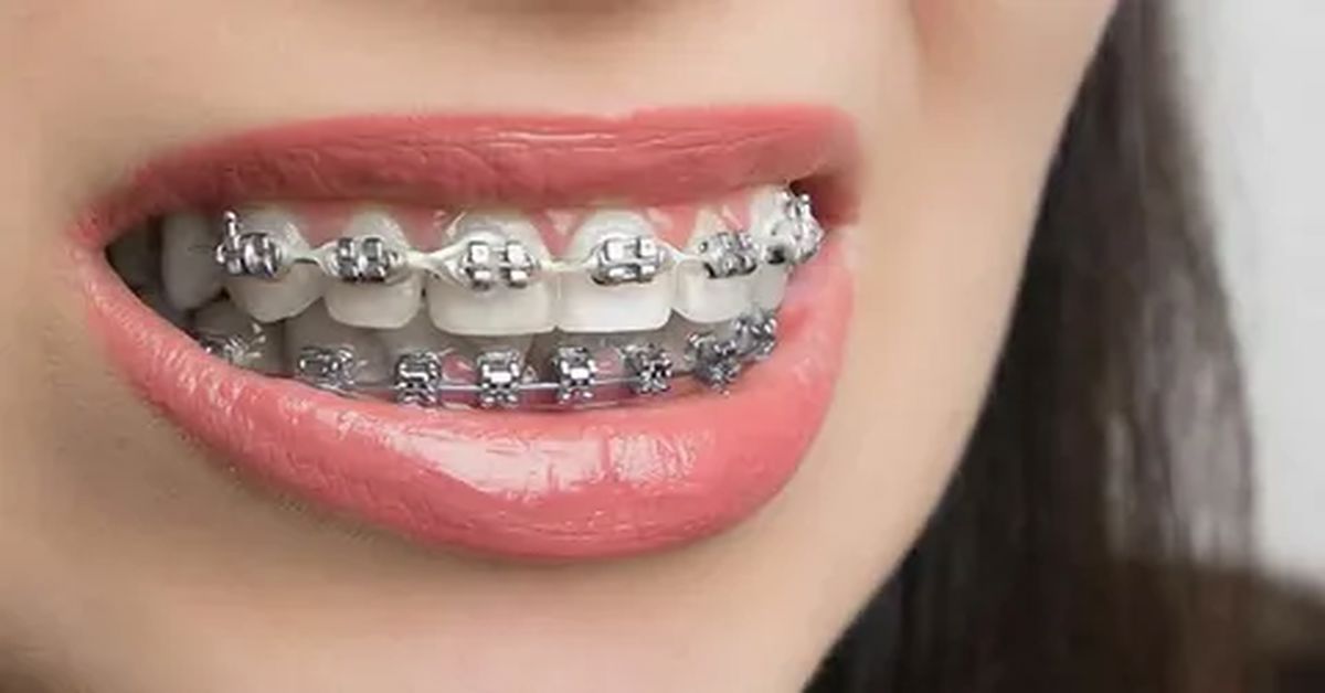 Лечение брекетами