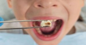 Diş Çürüğü Belirtileri