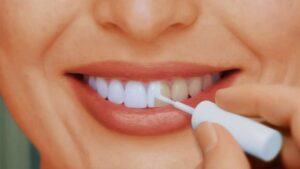 Процесс отбеливания зубов