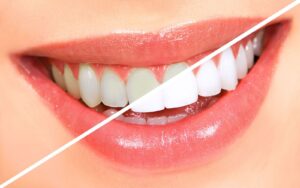 Diş Estetiği Çeşitleri