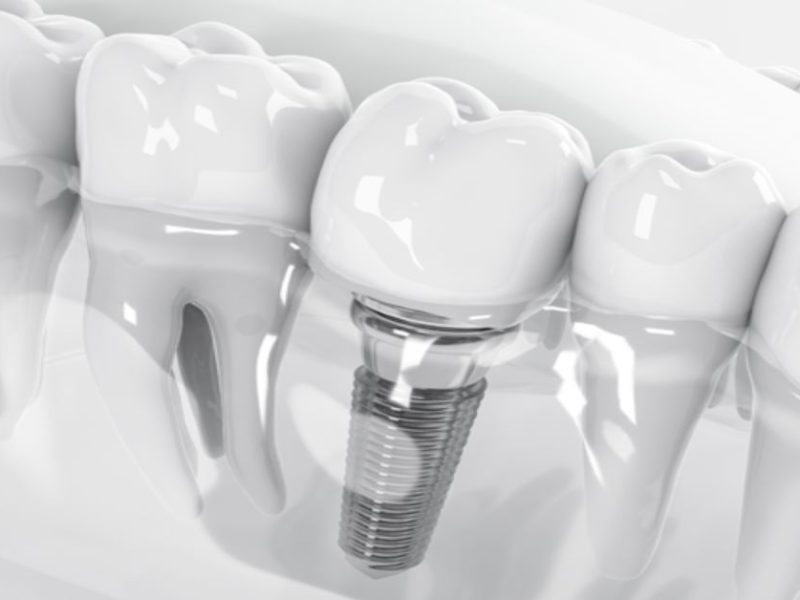 İmplant Tedavisi Süreci