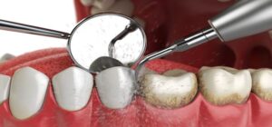 Процесс очистки зубного камня
