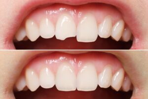 Что такое лечение зубов ламинатом?