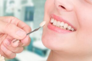 Что такое лечение зубов ламинатом?