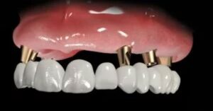 Protez Diş Tedavisi Nedir?