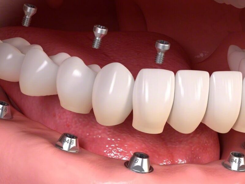 Protez Diş Tedavisi Nedir?