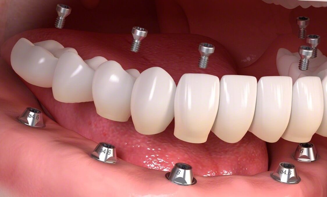 Protez Diş Tedavisi Nedir?