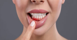 Заболевания десен