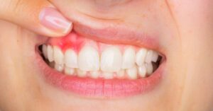 Заболевания десен