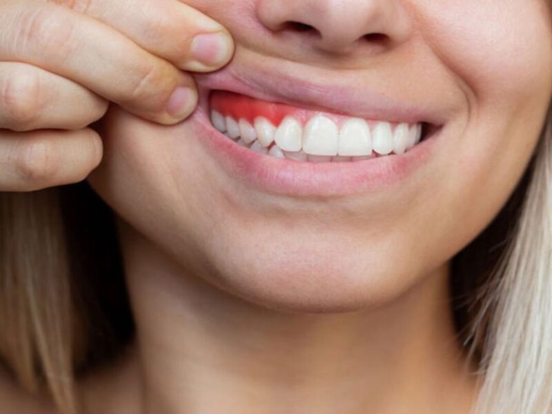 Diş Eti Hastalıkları