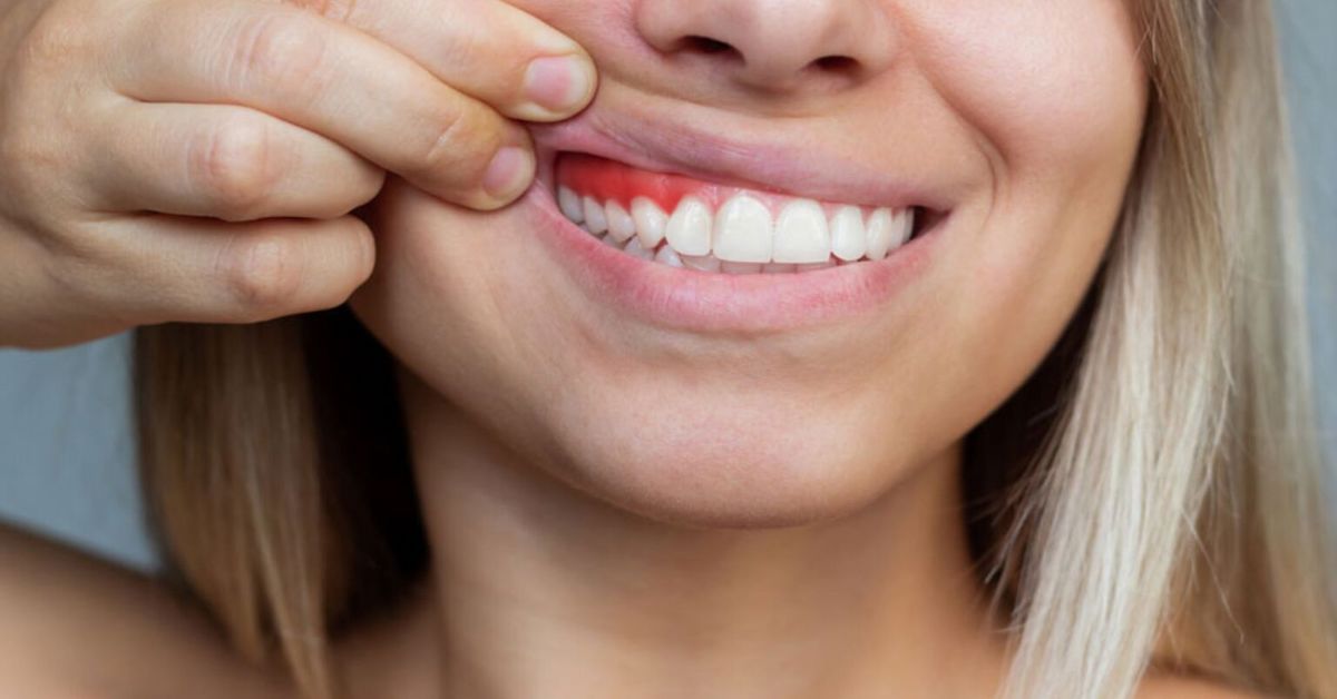 Заболевания десен