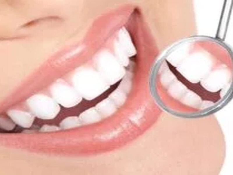 Estetik Gülüş Tasarımı