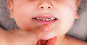 Çocuklarda Diş Çürüğü