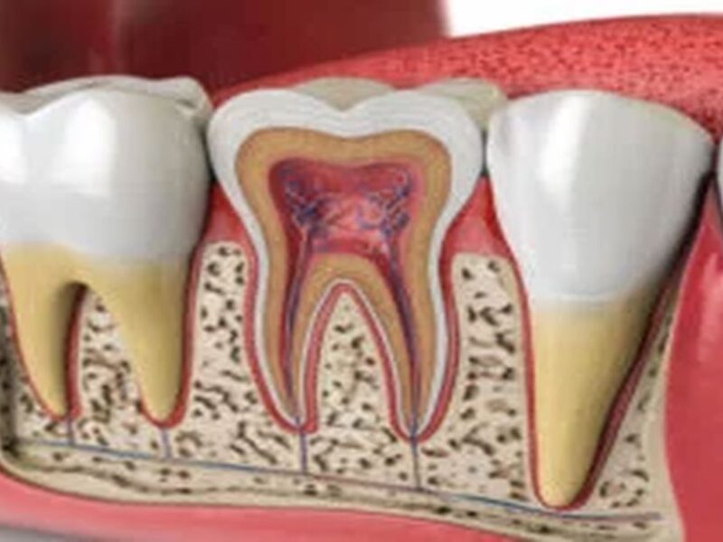 Diş Kanal Tedavisi Nedir?