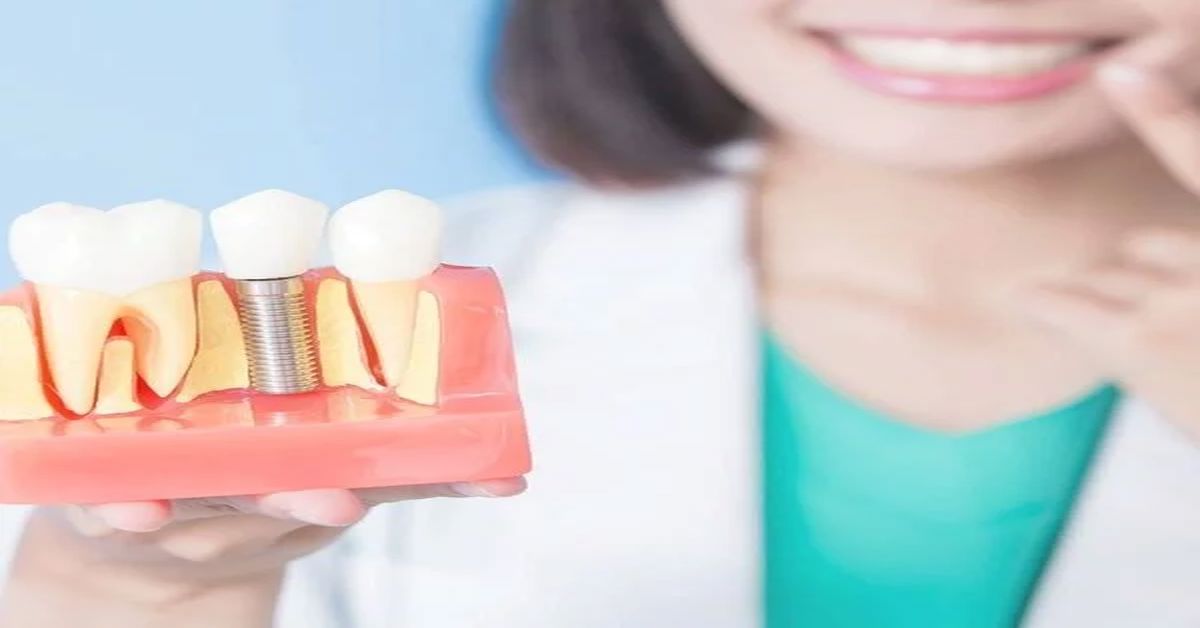 Diş İmplantı Nedir?