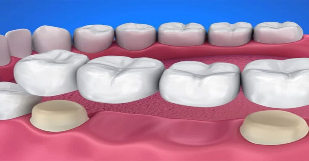 Kron Rrustemi Kron Köprü Nedir? | Erçağ Diş Kliniği