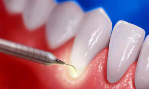 Periodontoloji Tedavisi Nedir?