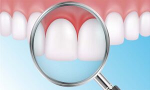 Periodontoloji Tedavisi Nedir?