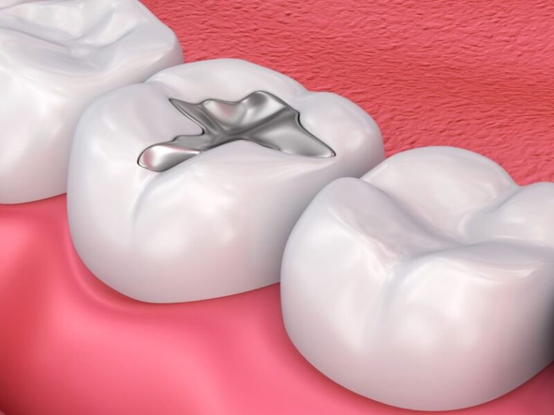 Kompozit Dolgu Tedavisi