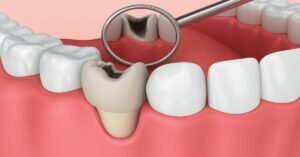 Çürük Diş Çekimi