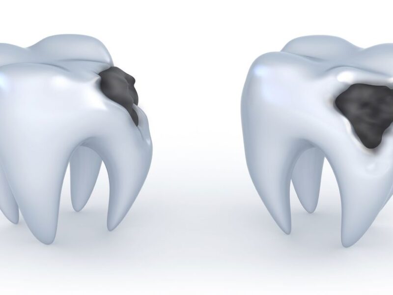 Çürük Diş Çekimi