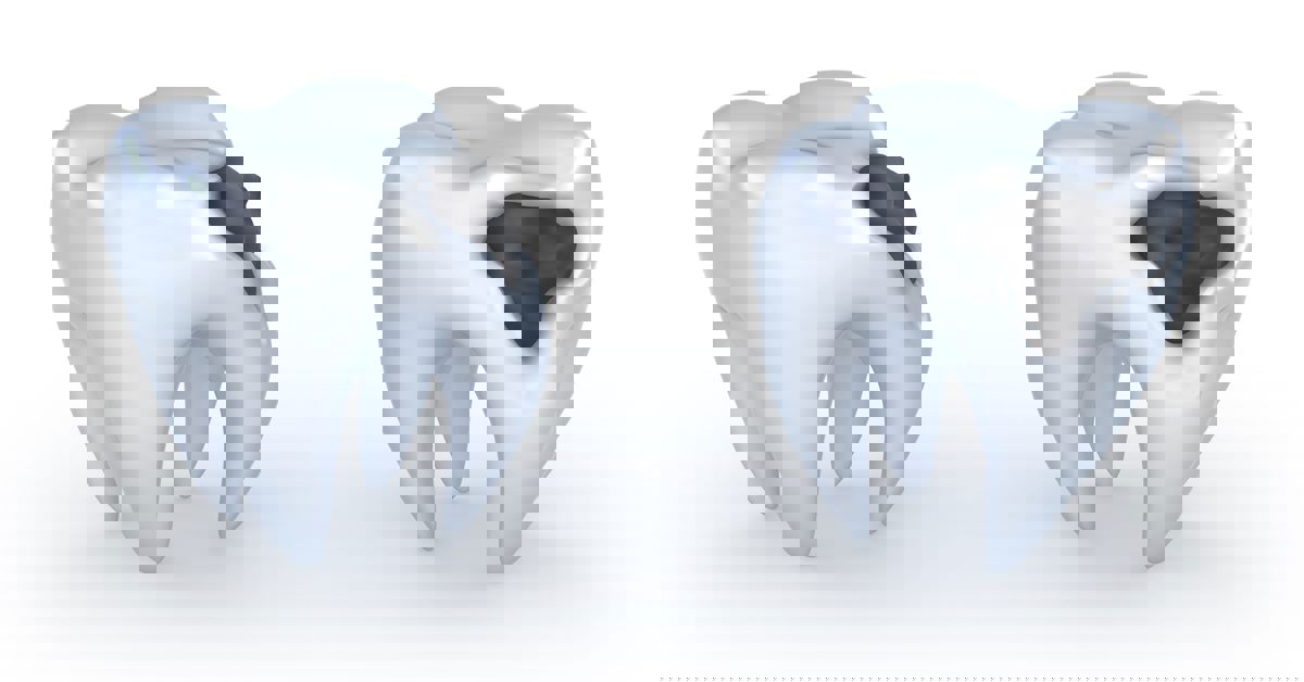 Çürük Diş Çekimi