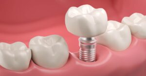 Zirkonyum İmplant Nasıl Yapılır? Zirkonyum İmplant Nasıl Yapılır?